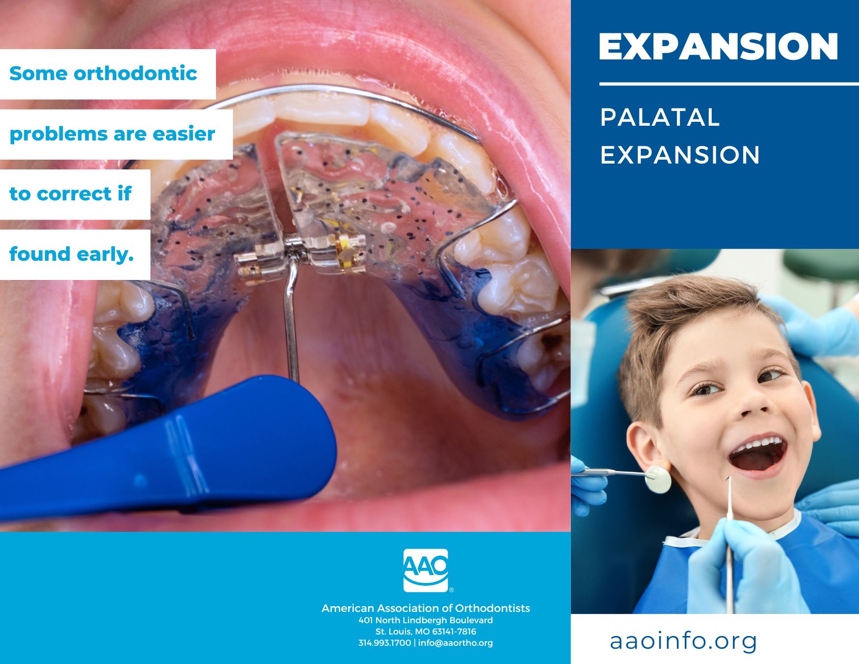 Palatal Expansion